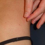 Dry needling behandeling nekklachten hoofdpijn